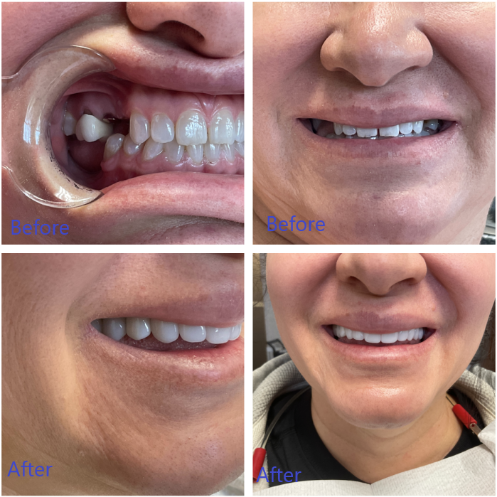 Before and After Dental Implants in Arvada, CO