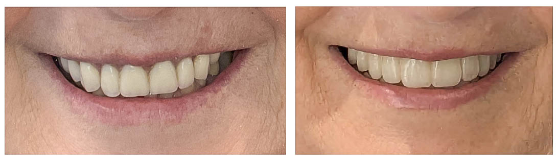 Invisalign Clear Aligners in Arvada, CO