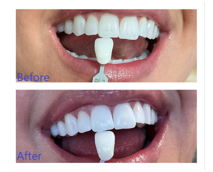 Before and After Teeth Whitening in Arvada, CO